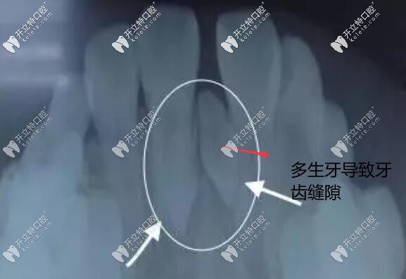 多生牙导致牙缝