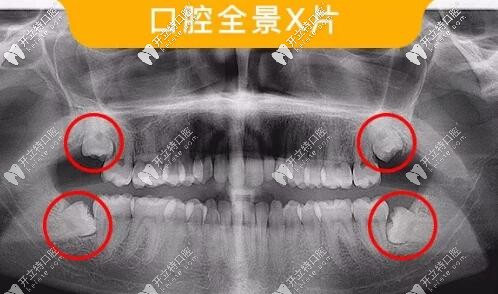 智齿口腔全景片