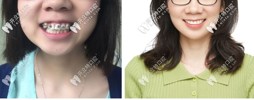 爆我箍牙前后脸型对比照图，你还觉得门牙外凸没必要矫正