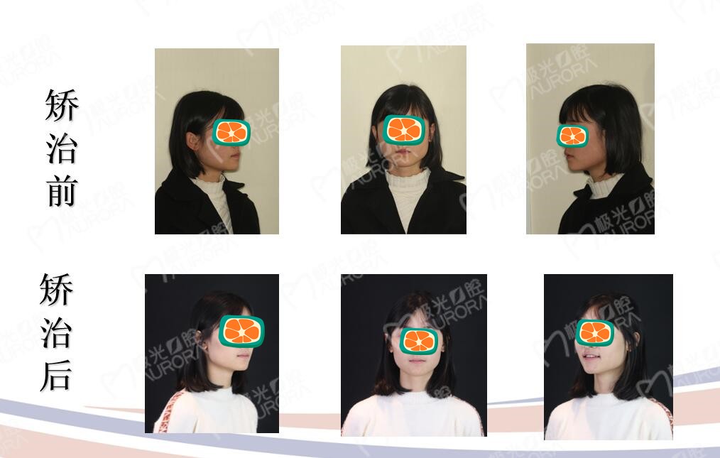 谁说25岁矫正牙齿没必要,在成都门牙地包天矫正后也很漂亮