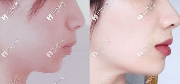 请看凸嘴戴钢牙套的侧脸变化图,整牙真的可以实现大逆转