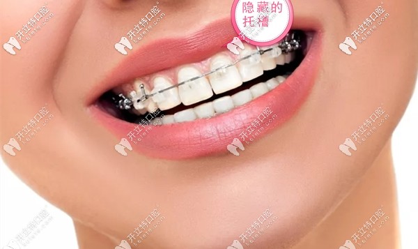 戴冰晶半隐形牙套的禁忌事项