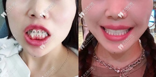 你想看上排牙齿突出用国产钢牙套箍牙齿2年后的效果吗