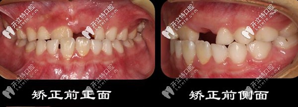我家孩子牙齿骨性反颌,7岁戴钢丝固定矫正器的效果就在这