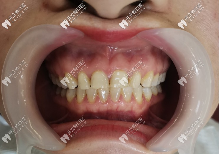 分享我在大方牙管家做树脂贴面的效果~四环素牙终于变白了