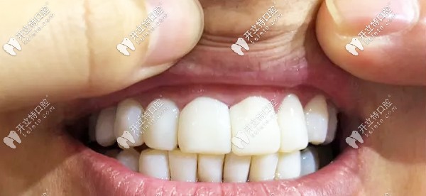 做了牙贴面感觉像龅牙怎么办,可以拆了重新做么?