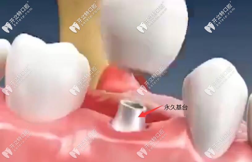 种牙三期戴永 久基台和牙冠过程 种牙三期戴永 久基台和牙冠过程