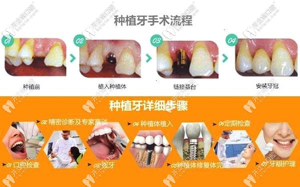 超详细的种植牙二期上基台步骤