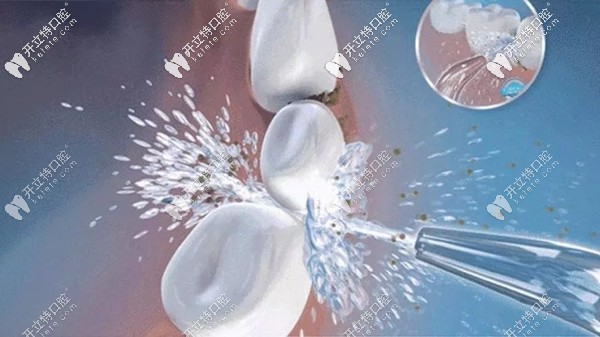 参照洗牙的分类等级表来自测你的牙齿需要做几级洗护